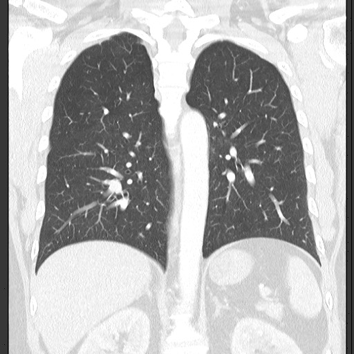 Bronchial carcinoid tumor (Radiopaedia 67377-76764 Coronal lung window 44).jpg
