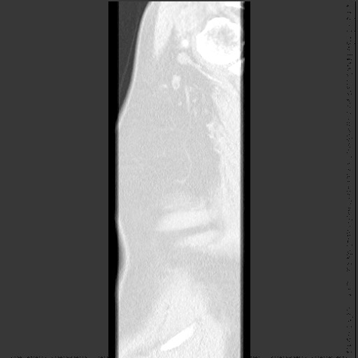 Bronchial carcinoid tumor (Radiopaedia 67377-76764 Sagittal lung window 68).jpg