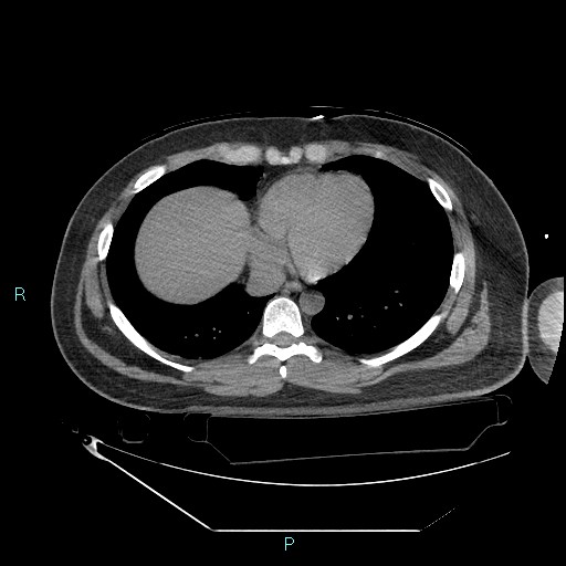 File:Bronchial carcinoid tumor (Radiopaedia 78272-90870 Axial non-contrast 75).jpg