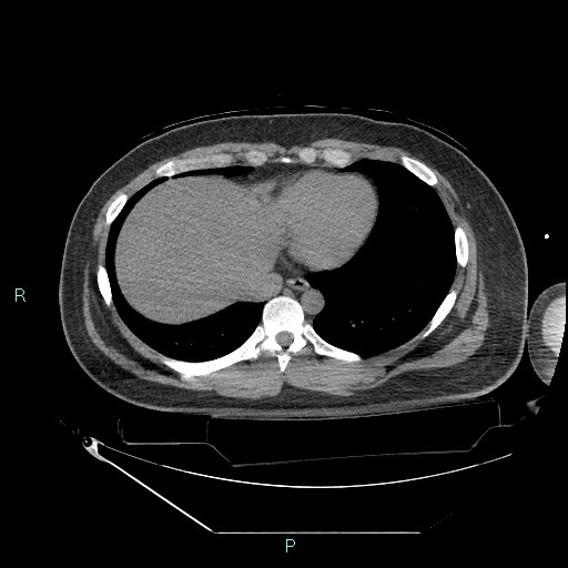Bronchial carcinoid tumor (Radiopaedia 78272-90870 Axial non-contrast 81).jpg