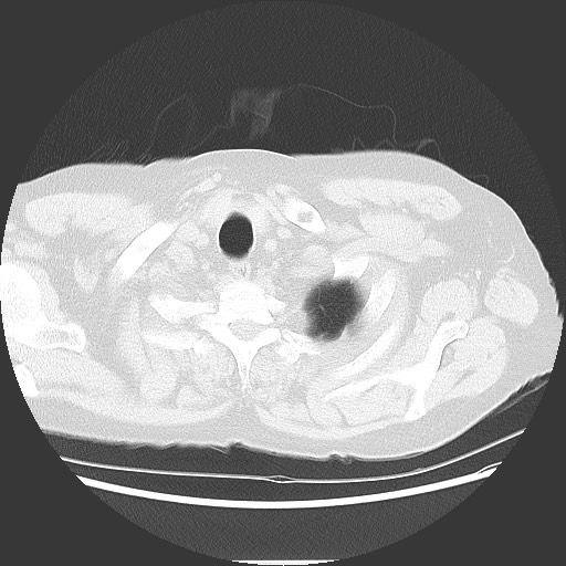 Bronchial stenosis - lung transplant (Radiopaedia 73133-83848 Axial lung window 6).jpg