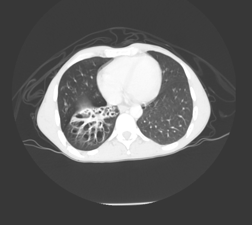 File:Bronchiectasis in Crohn disease (Radiopaedia 60311-67977 Axial lung window 10).jpg
