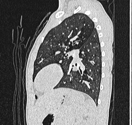 Bronchiolitis obliterans (Radiopaedia 71538-81897 Sagittal lung window 49).jpg