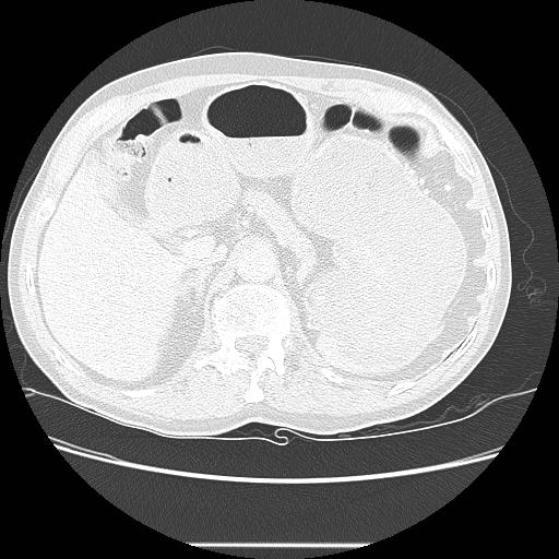 Bronchocele (Radiopaedia 17097-16795 Axial lung window 119).jpg