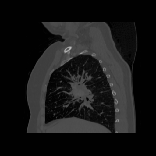 Bronchogenic carcinoma (Radiopaedia 73497-84262 Sagittal bone window 62).jpg