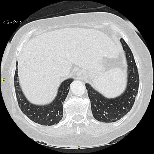 Bronchogenic carcinoma as an incidental finding (Radiopaedia 16453-16130 Axial lung window 24).jpg