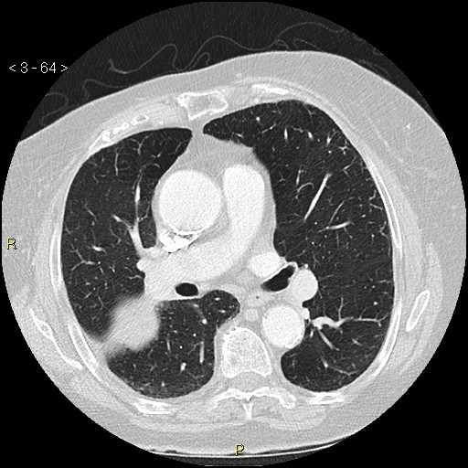 Bronchogenic carcinoma as an incidental finding (Radiopaedia 16453-16130 Axial lung window 64).jpg
