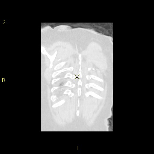 File:Bronchogenic carcinoma as an incidental finding (Radiopaedia 16453-16130 Coronal lung window 44).jpg
