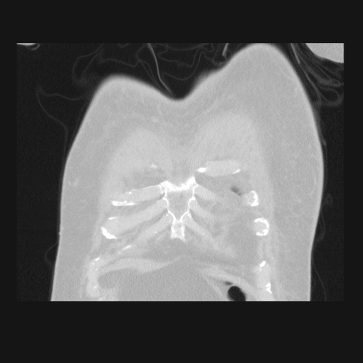 File:Bronchogenic carcinoma with metastatic lymphadenopathy (Radiopaedia 37671-39569 Coronal lung window 5).jpg