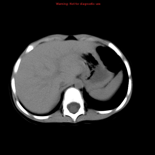 File:Bronchogenic cyst (Radiopaedia 9372-10063 Axial non-contrast 17).jpg