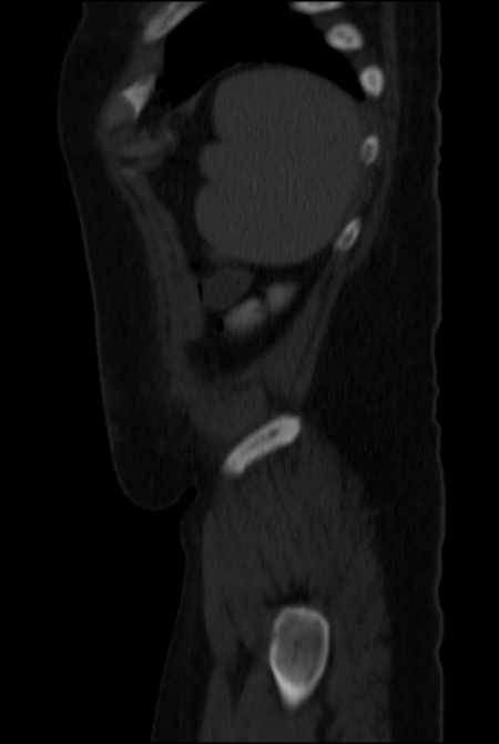 Brown tumors compressing the spinal cord (Radiopaedia 68442-77988 H 50).jpg