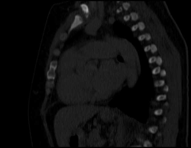 Brown tumors compressing the spinal cord (Radiopaedia 68442-77988 Sagittal bone window 34).jpg
