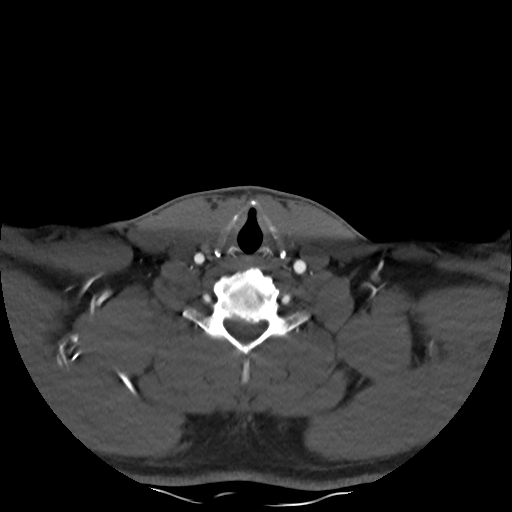 Buccal fat pad arteriovenous malformation (Radiopaedia 70936-81144 A 84).jpg