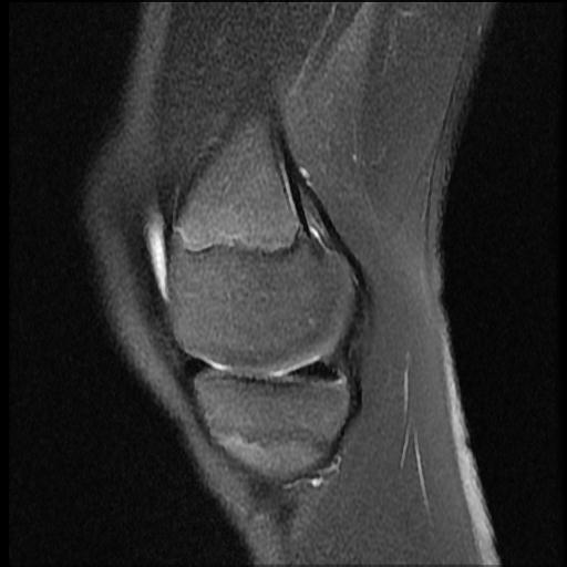 File:Bucket handle tear - lateral meniscus (Radiopaedia 72124-82634 Sagittal PD fat sat 12).jpg
