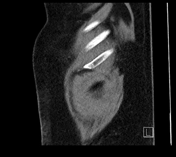 Buried bumper syndrome - gastrostomy tube (Radiopaedia 63843-72577 Sagittal Inject 5).jpg