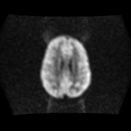 File:Burkitt lymphoma of the orbit- pre and post chemotherapy (Radiopaedia 31214-31930 Axial DWI 12).jpg