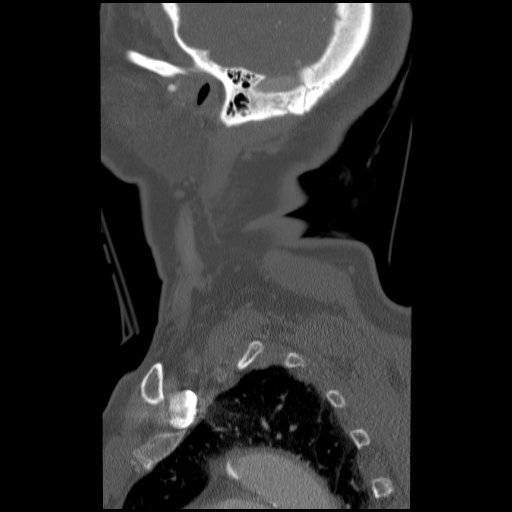File:C1 anterior arch (plough) fracture - type 1 (Radiopaedia 76181-87720 Sagittal bone window 14).jpg