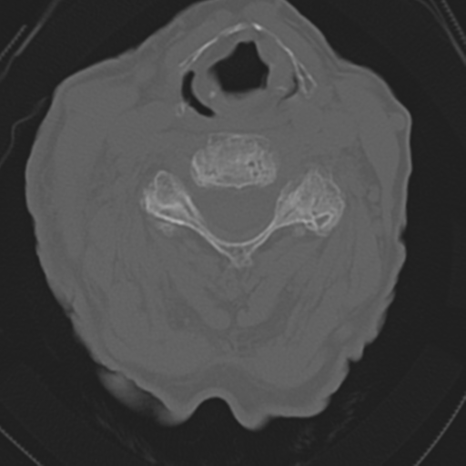 File:C2 fracture with vertebral artery dissection (Radiopaedia 37378-39199 Axial bone window 29).png