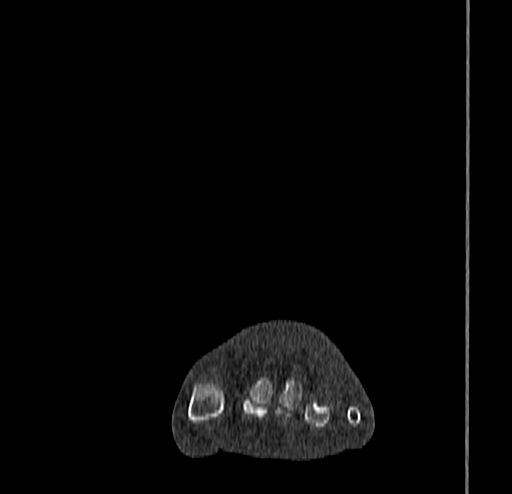 Calcaneal fracture - Sanders type 4 (Radiopaedia 90179-107370 Coronal bone window 20).jpg
