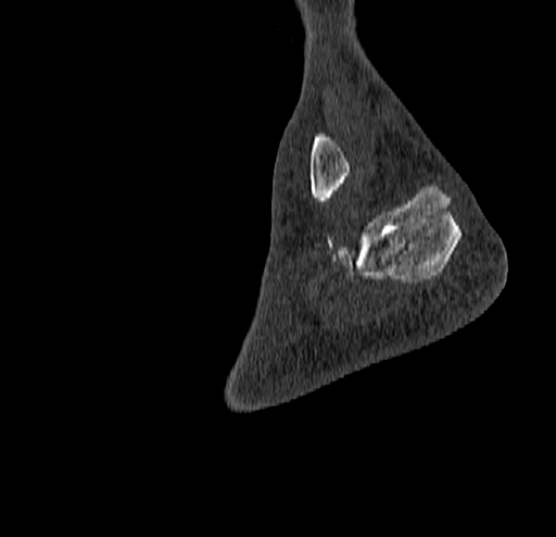 File:Calcaneal fracture - Sanders type 4 (Radiopaedia 90179-107370 Sagittal bone window 74).jpg