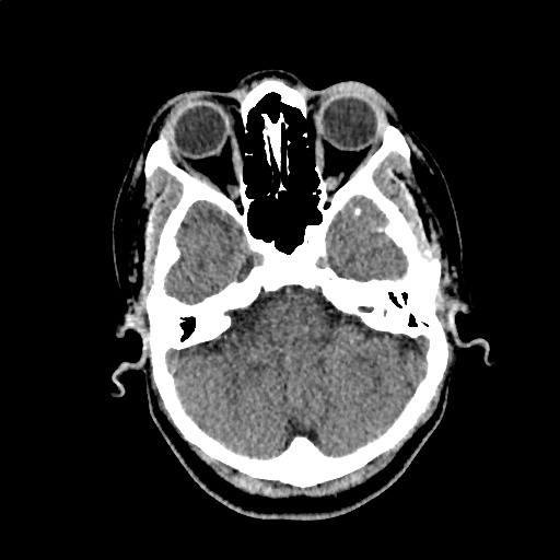 Calcified cerebral hydatid cyst (Radiopaedia 65603-74717 Axial non-contrast 10).jpg