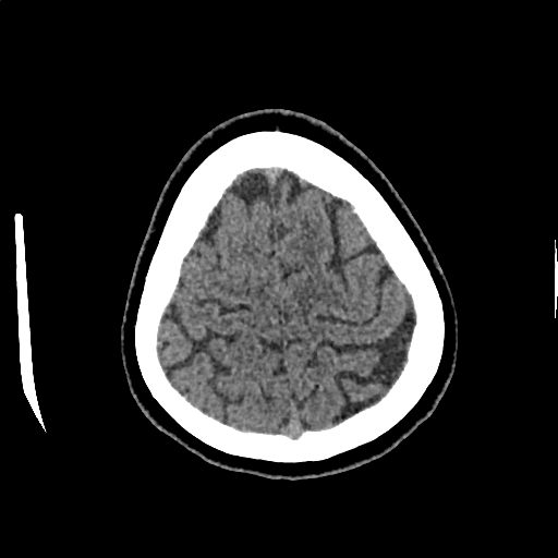 Calcified cerebral hydatid cyst (Radiopaedia 65603-74717 Axial non-contrast 69).jpg