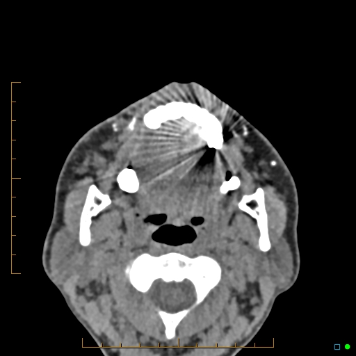 Calcified facial augmentation fillers (Radiopaedia 79514-92679 Axial non-contrast 96).jpg