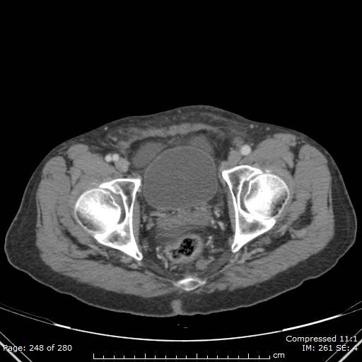 Calcified liver metastases (Radiopaedia 44699-48470 B 59).jpg