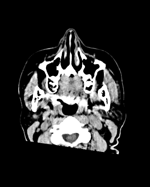 Calcified meningioma (Radiopaedia 74361-85243 Axial non-contrast 61).jpg