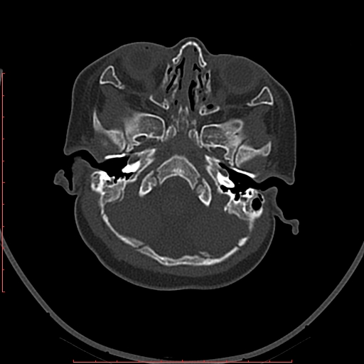 Calcified middle cerebral artery embolism (Radiopaedia 78949-91860 Axial bone window 1).jpg