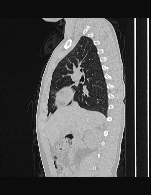 Calcifying pulmonary metastases (Radiopaedia 33359-34396 Sagittal lung window 44).jpg