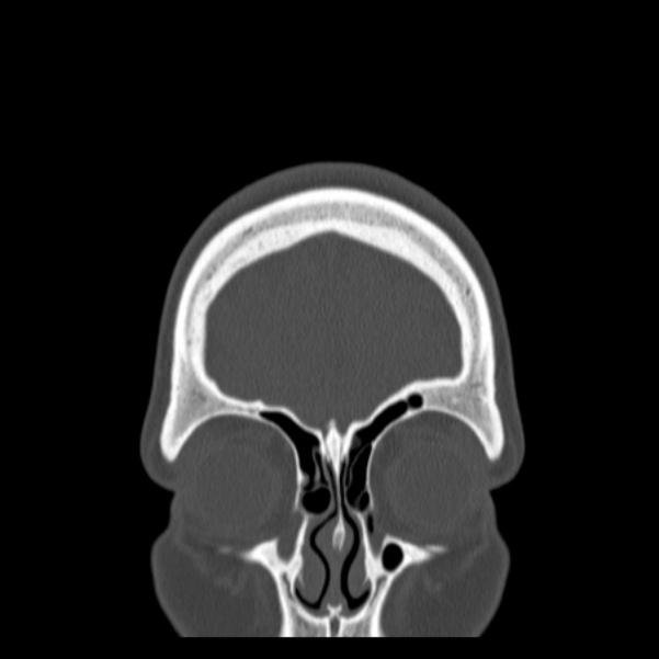 Calvarial osteoma (Radiopaedia 36520-38079 C 15).jpg