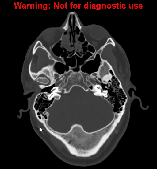 Calvarial thickening from chronic shunting (Radiopaedia 60079-67637 Axial bone window 35).jpg