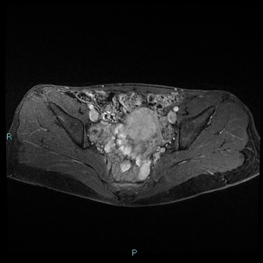 File:Canal of Nuck cyst (Radiopaedia 55074-61448 Axial T1 C+ fat sat 27).jpg