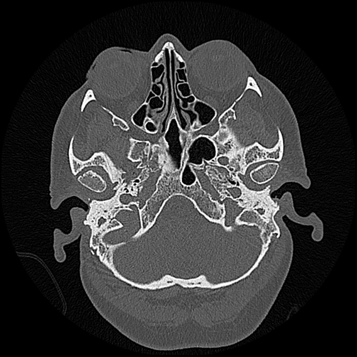Canal up mastoidectomy (Radiopaedia 78108-90638 Axial bone window 38).jpg