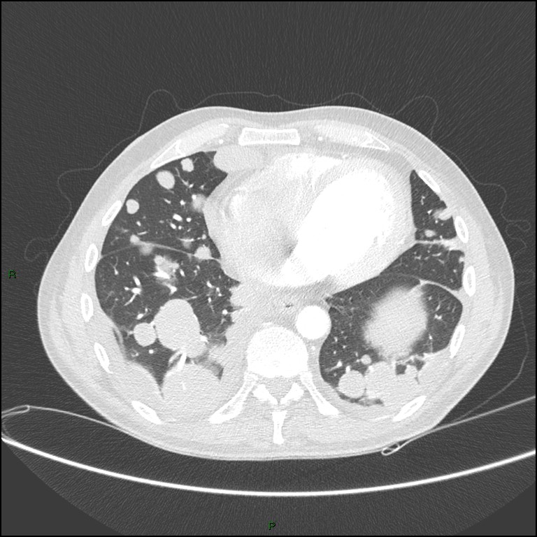 Cannonball metastases (Radiopaedia 82110-96150 Axial lung window 135).jpg