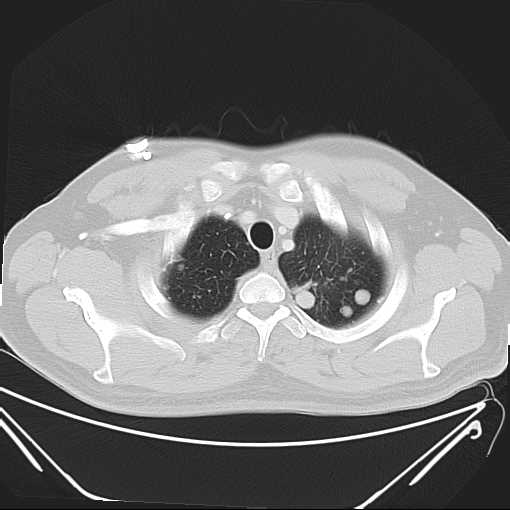 File:Cannonball pulmonary metastases (Radiopaedia 67684-77101 Axial lung window 3).jpg