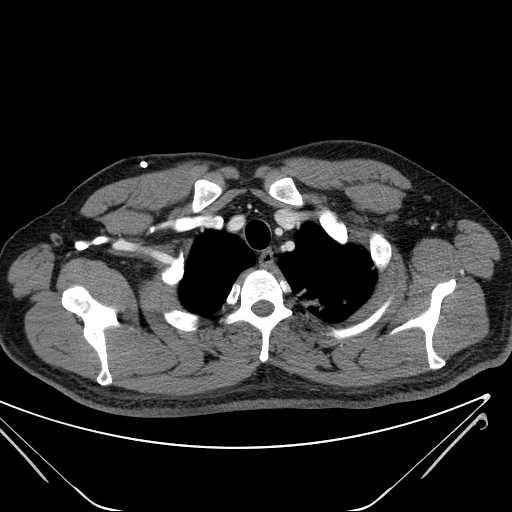 File:Cannonball pulmonary metastases (Radiopaedia 67684-77101 D 35).jpg