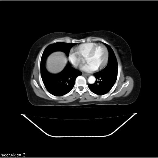 Carcinoma cervix- recurrence (Radiopaedia 34702-36137 B 3).jpg