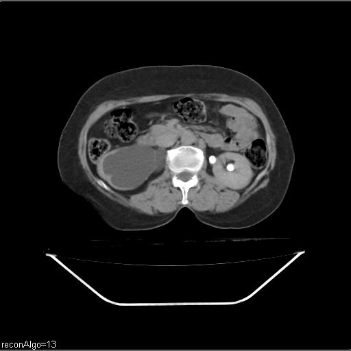 Carcinoma cervix- recurrence (Radiopaedia 34702-36137 B 73).jpg