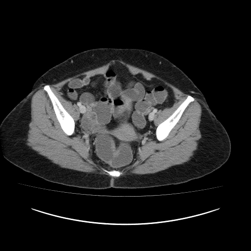 File:Carcinoma colon - hepatic flexure (Radiopaedia 19461-19493 A 110).jpg