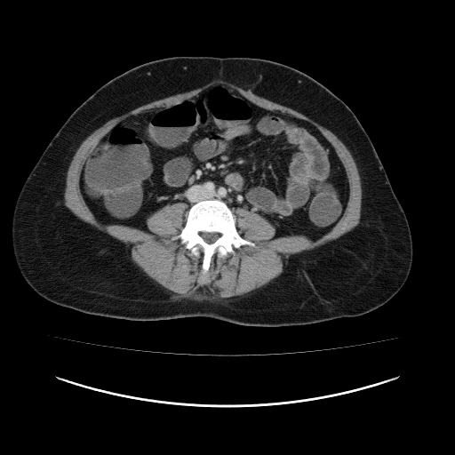 Carcinoma colon - hepatic flexure (Radiopaedia 19461-19493 A 75).jpg