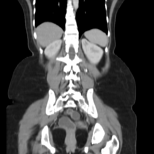 File:Carcinoma colon - hepatic flexure (Radiopaedia 19461-19493 B 30).jpg