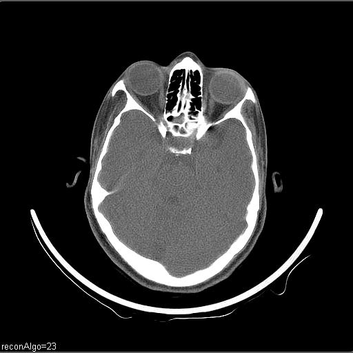 Carcinoma of the maxillary antrum (Radiopaedia 53805-59888 Axial non-contrast 74).jpg