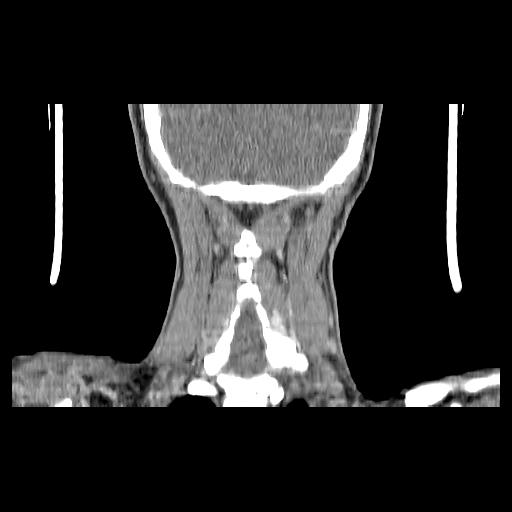 Carcinoma of the maxillary antrum (Radiopaedia 53805-59888 Coronal C+ delayed 137).jpg