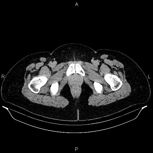File:Carcinoma of uterine cervix (Radiopaedia 85861-101700 Axial C+ delayed 94).jpg