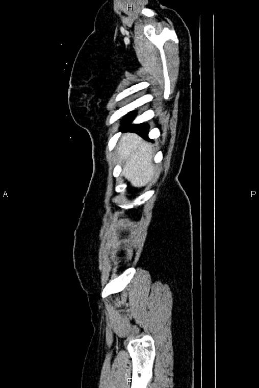 Carcinoma of uterine cervix (Radiopaedia 85861-101700 D 1).jpg
