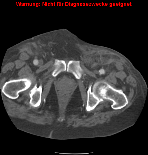 File:Cardiac perforation following transcatheter aortic valve implantation (Radiopaedia 23714-23863 B 11).png