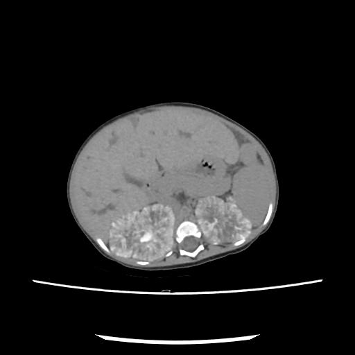 File:Caroli disease with autosomal recessive polycystic kidney disease (ARPKD) (Radiopaedia 89651-106703 E 81).jpg