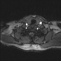 Carotid artery dissection (Radiopaedia 28441-28689 Axial MRA 16).jpg